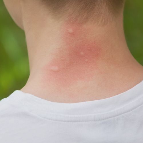 Allergische reactie muggenbeet