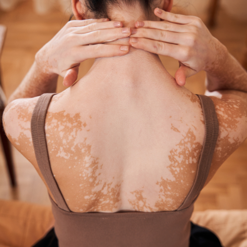 Vitiligo kenmerkt zich aan witte vlekken