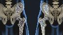Osteoporose voorkomen en behandelen